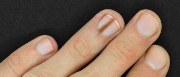 If You Have This Mark on Your Nail, You Should Get Checked for Cancer