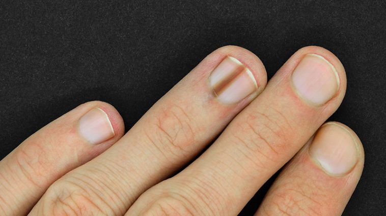 If You Have This Mark on Your Nail, You Should Get Checked for Cancer