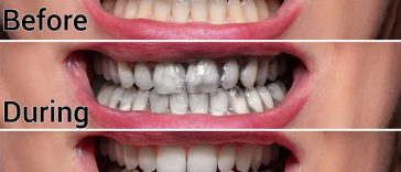 Ten Easy Ways to Naturally Whiten Your Teeth At Home Without Damaging Them