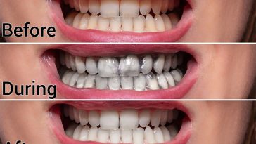 Ten Easy Ways to Naturally Whiten Your Teeth At Home Without Damaging Them