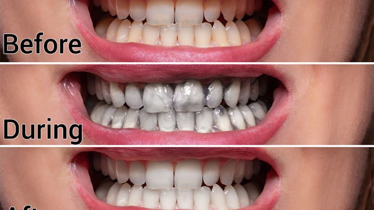 Ten Easy Ways to Naturally Whiten Your Teeth At Home Without Damaging Them