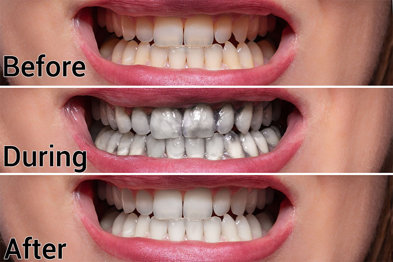 How To Get White Teeth At Home Without Baking Soda at Gregory Hines blog