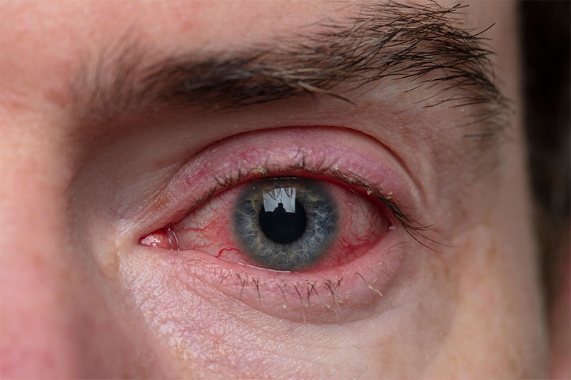 This Serious Condition Can Show Through Bloodshot Eyes