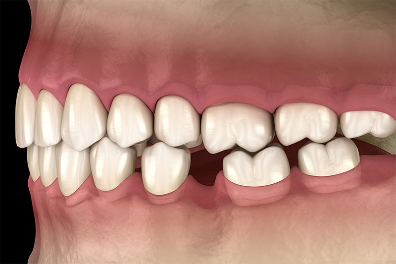 Teeth Alignment Shifting