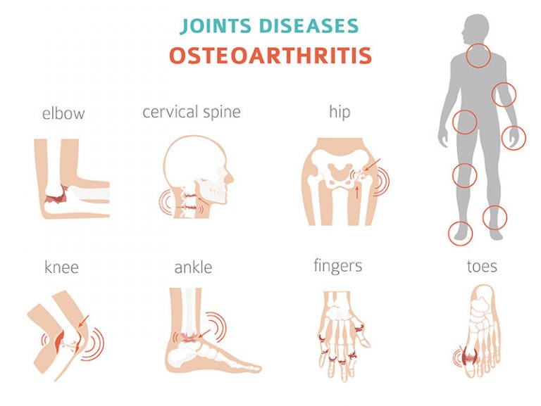 10 Types Of Arthritis You Could Have And How To Tell The Difference Factspedia 3629