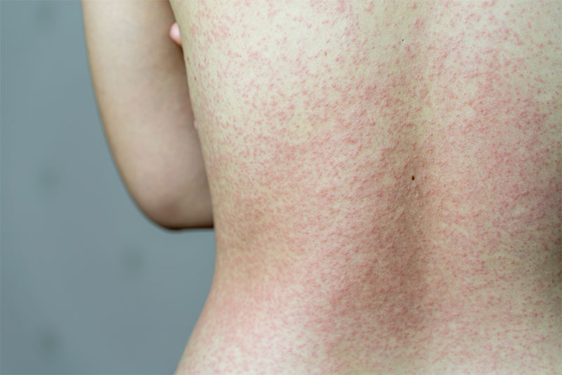 Wide-Spread Rash