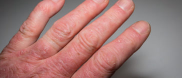 Psoriatic Arthritis