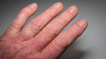 Psoriatic Arthritis