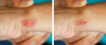 6 Nutrients Essential for Wound Healing You Should Know About