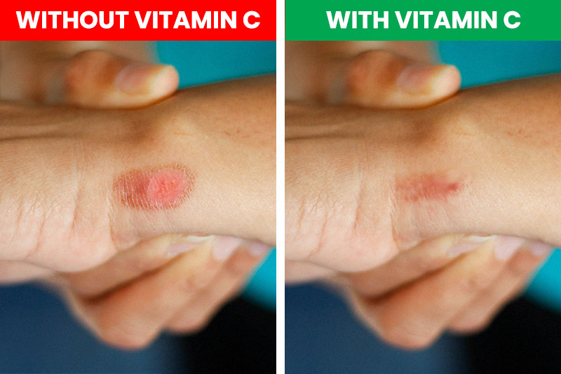 6 Nutrients Essential for Wound Healing You Should Know About