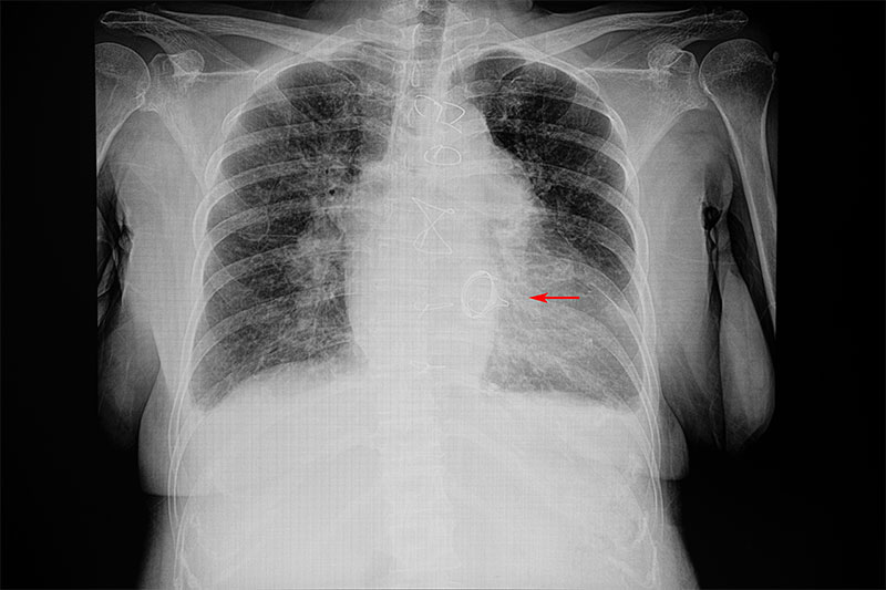 Left Ventricular Hypertrophy or Cardiac Enlargement