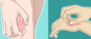 10 Times You Should Never, Ever Scratch an Itch