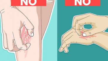 10 Times You Should Never, Ever Scratch an Itch