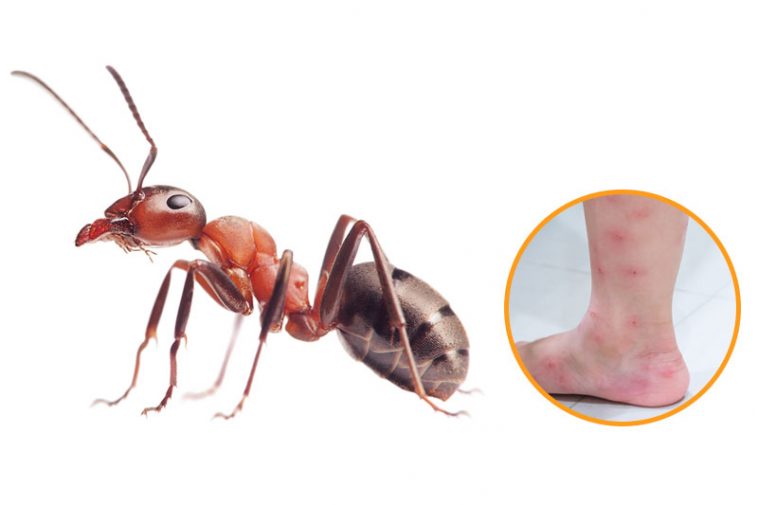 12 Bug Bites Anyone Should Be Able To Identify Factspedia 12 Bug Bites Anyone Should Be Able To Identify Factspedia