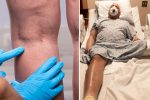9 Things You Can Do to Prevent DVT, A Deadly Blood Clot In Your Leg