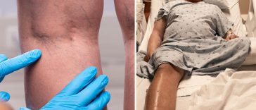 9 Things You Can Do to Prevent DVT, A Deadly Blood Clot In Your Leg