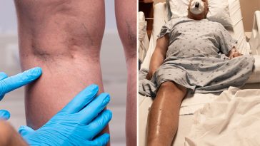 9 Things You Can Do to Prevent DVT, A Deadly Blood Clot In Your Leg