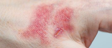 You Can Tell If A Cut Is Infected By Looking Out For These 5 Symptoms