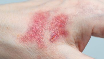 You Can Tell If A Cut Is Infected By Looking Out For These 5 Symptoms