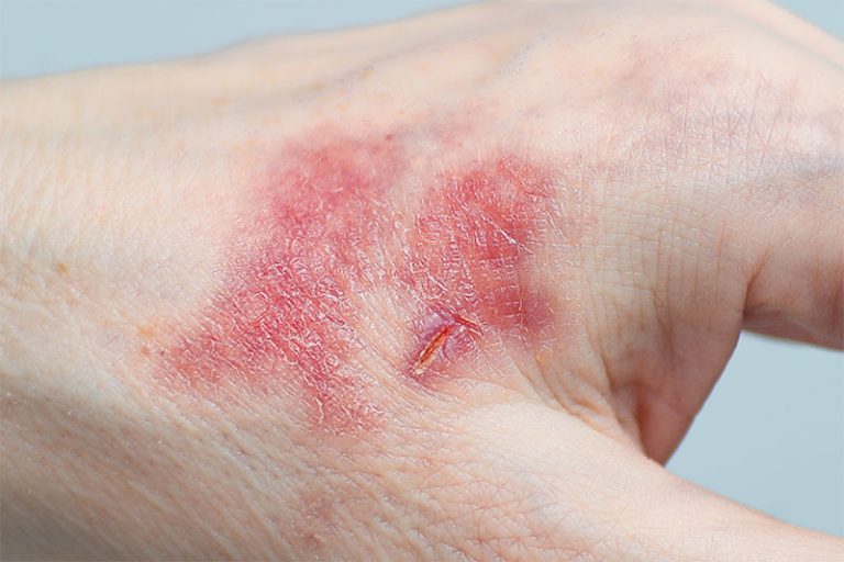 You Can Tell If A Cut Is Infected By Looking Out For These 5 Symptoms 