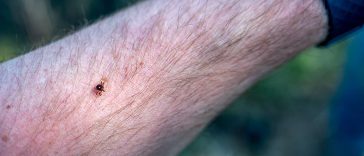 The Bizarre Link Between Lone Star Tick Bites and Red Meat Allergies