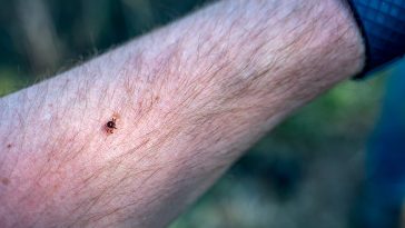 The Bizarre Link Between Lone Star Tick Bites and Red Meat Allergies