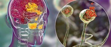 If You Have A Chronic Blocked Nose, It May Be Due To Brain Activity Changes