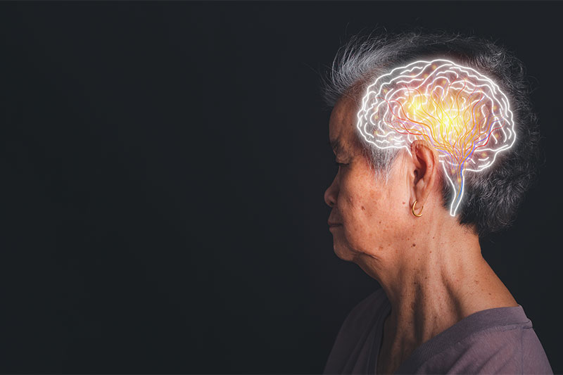 Mental Decline Could Predict a Stroke 10 Years Before It Happens