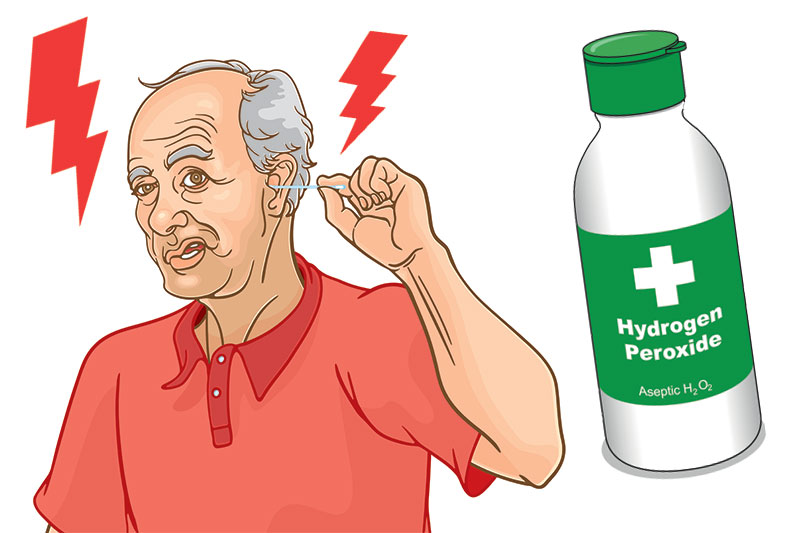 Should You Use Hydrogen Peroxide To Clean Earwax?