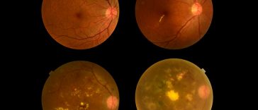 What Are The Four Types Of Eye Problems Caused By Diabetes?