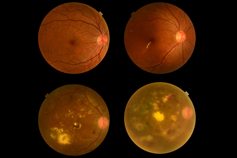 What Are The Four Types Of Eye Problems Caused By Diabetes?