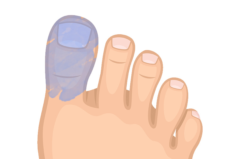 Your Toes Turn Blue and Cold When Exposed to Lower Temperatures