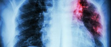 12 Warning Signs Your Lungs Are Yelling for Immediate Help