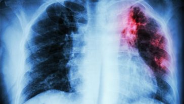 12 Warning Signs Your Lungs Are Yelling for Immediate Help