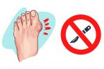 Easy Ways to Shrink Your Bunions Without Surgery