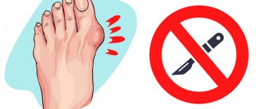 Easy Ways to Shrink Your Bunions Without Surgery