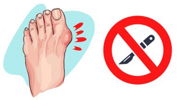 Easy Ways to Shrink Your Bunions Without Surgery