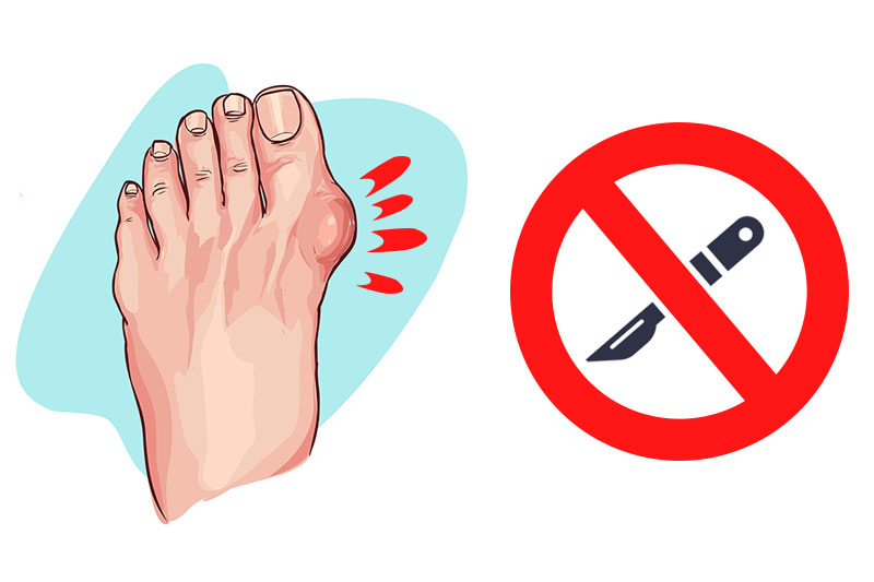 Easy Ways to Shrink Your Bunions Without Surgery