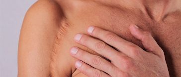 You Can Make Unsightly Scars Less Visible