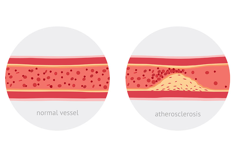 19 Foods that You Should Eat for Clean Arteries