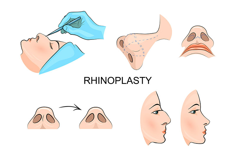 Get a Nose Job rhinoplasty