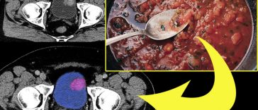 Scientists Identify 9 Foods That Reduce the Risk of Bladder Cancer