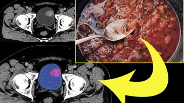 Scientists Identify 9 Foods That Reduce the Risk of Bladder Cancer