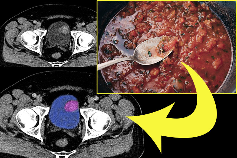 Scientists Identify 9 Foods That Reduce the Risk of Bladder Cancer