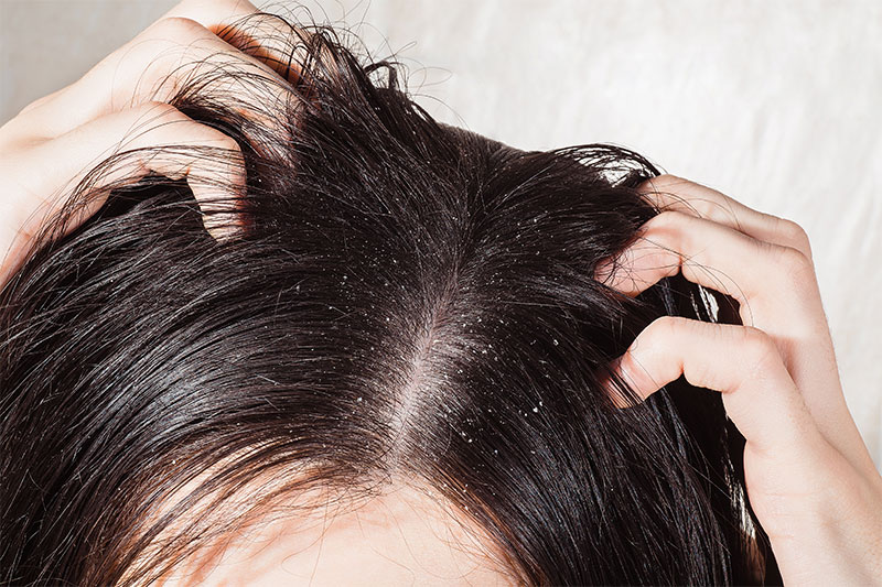 Get Rid of Dandruff with listerine