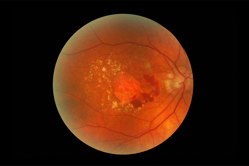 Retina - macular degeneration, hemorrhages and exudates