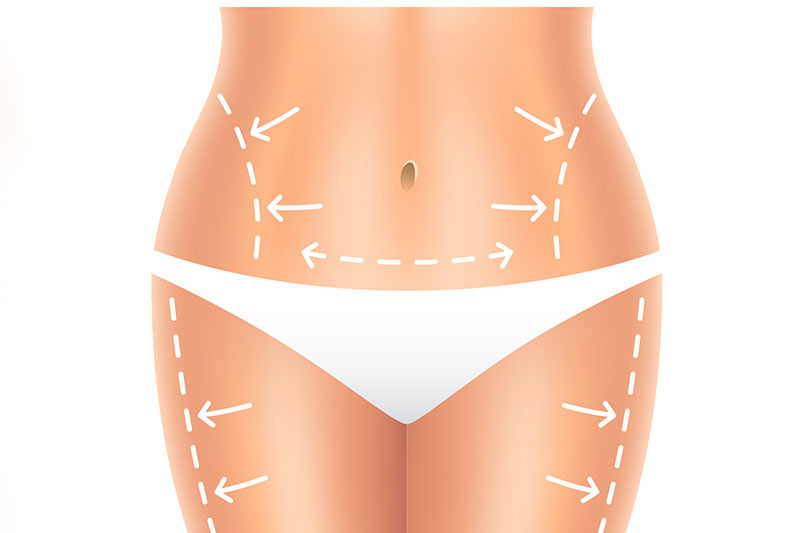 Tummy Tuck surgery covered by insurance