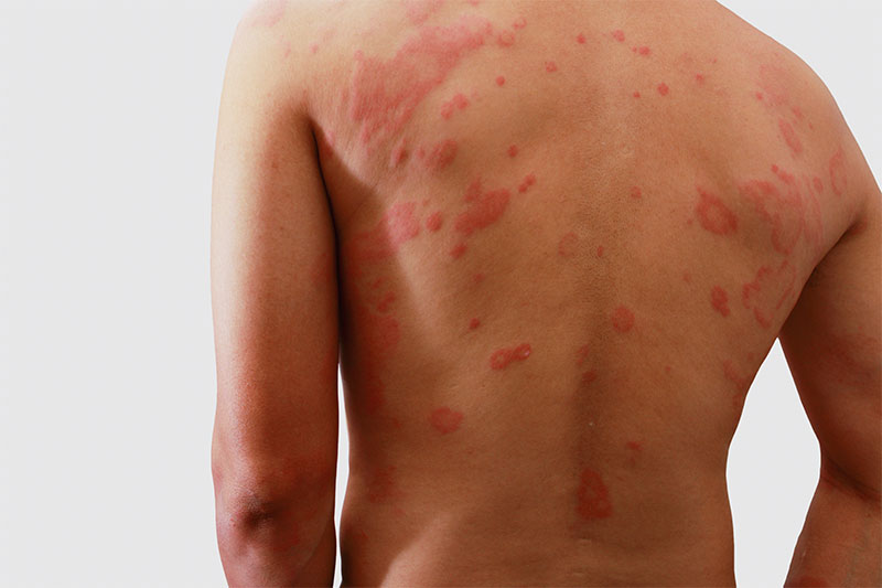 Your Rash Changes Color And Worsens