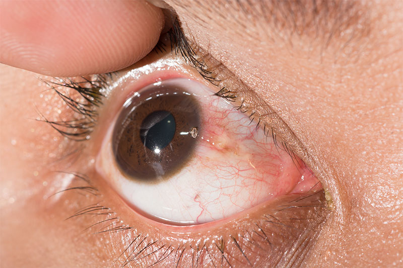 Some Foreign Body might be Irritating Your Eye