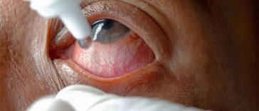 Read This Before Using Eye-Whitening Drops